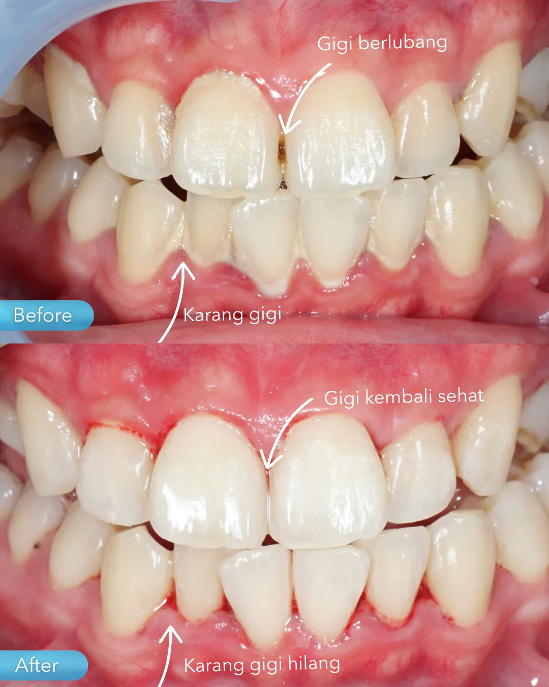 Dental filling result